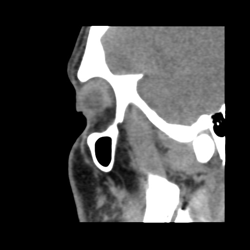 Normal CT paranasal sinuses (Radiopaedia 42286-45390 F 118).jpg