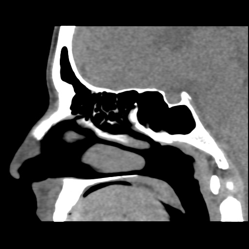 Normal CT paranasal sinuses (Radiopaedia 42286-45390 F 72).jpg
