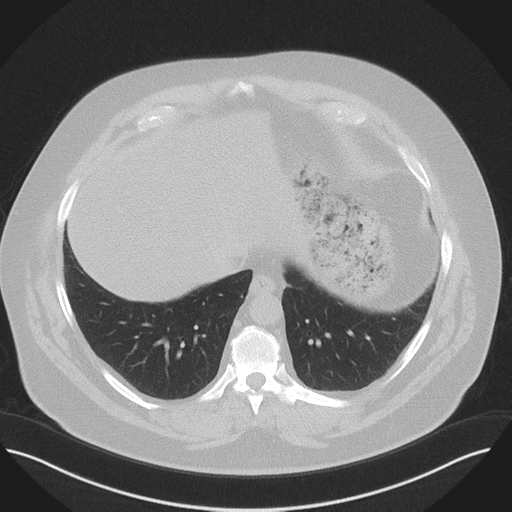 Normal HRCT (Radiopaedia 40797-43458 Axial lung window 45).png