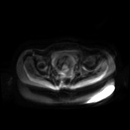 Normal MRI abdomen in pregnancy (Radiopaedia 88001-104541 Axial DWI 43).jpg