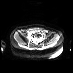 Normal MRI abdomen in pregnancy (Radiopaedia 88001-104541 Axial DWI 7).jpg