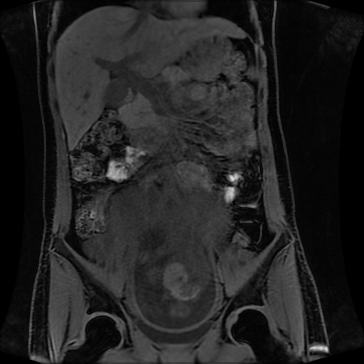 Normal MRI abdomen in pregnancy (Radiopaedia 88001-104541 M 67).jpg
