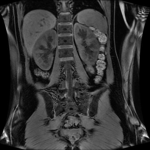 Normal MRI abdomen in pregnancy (Radiopaedia 88001-104541 M 98).jpg