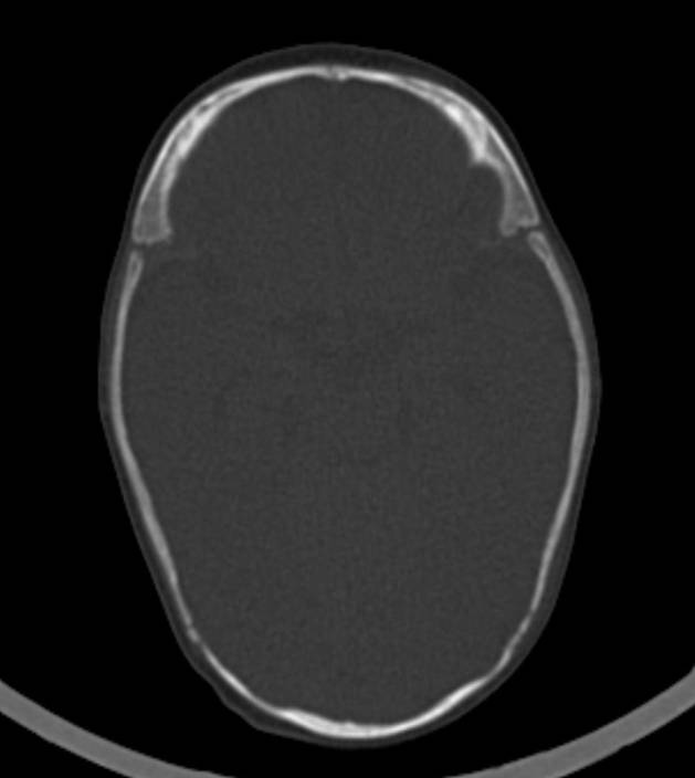 Normal brain CT - 2-month-old (Radiopaedia 53369-59350 Axial bone window 38).jpg