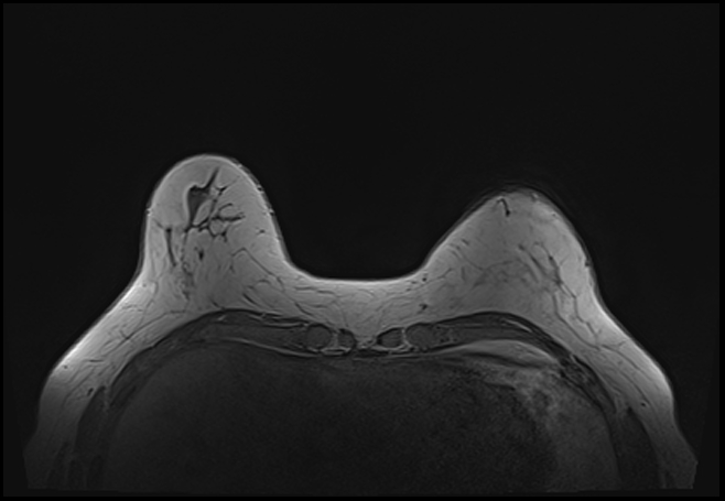 File:Normal breast MRI - dense breasts (Radiopaedia 80454-93850 Axial T1 46).jpg