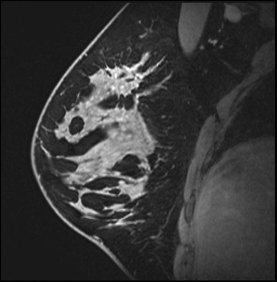 Normal breast MRI - dense breasts (Radiopaedia 80454-93850 I 71).jpg