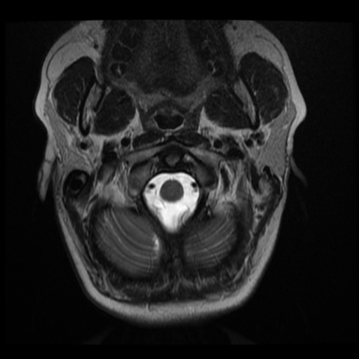 File:Normal cervical and thoracic spine MRI (Radiopaedia 35630-37156 Axial T2 32).png