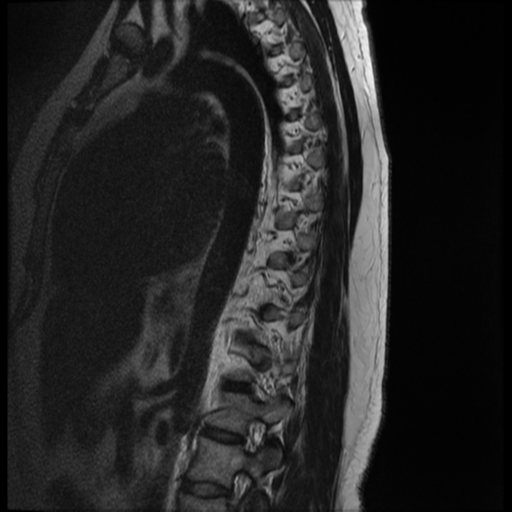 File:Normal cervical and thoracic spine MRI (Radiopaedia 35630-37156 G 2).png