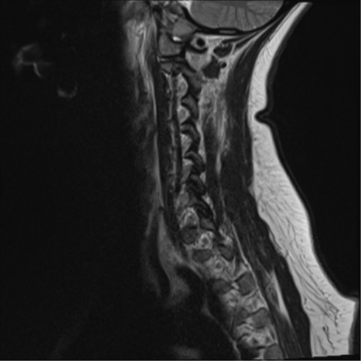 File:Normal cervical spine MRI (including Dixon) (Radiopaedia 42762-45925 Dixon- in-phase 3).png