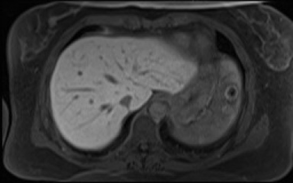 File:Normal hepatobiliary phase liver MRI (Radiopaedia 58968-66230 A 22).jpg