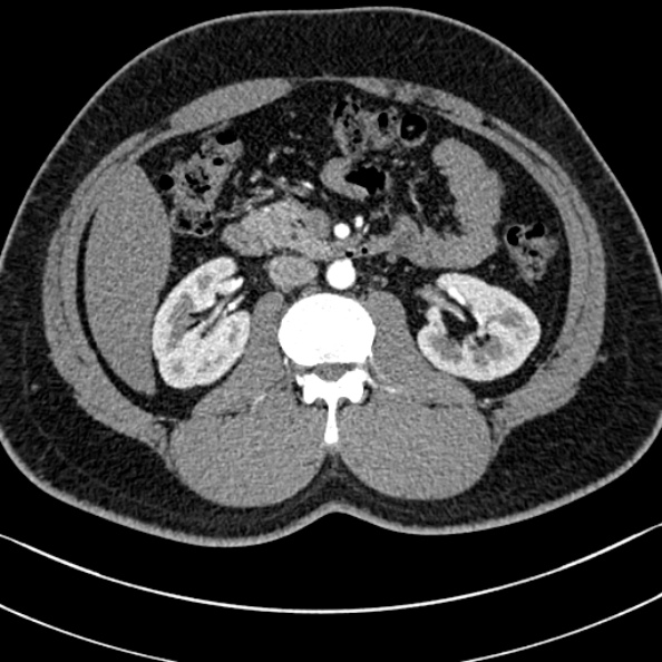 Normal kidneys on 4-phase CT study (Radiopaedia 25889-26038 B 43).jpg