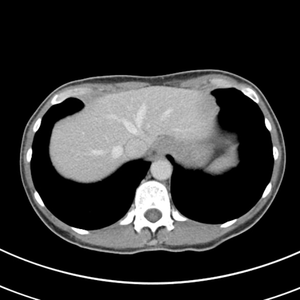 File:Normal multiphase CT liver (Radiopaedia 38026-39996 C 8).jpg