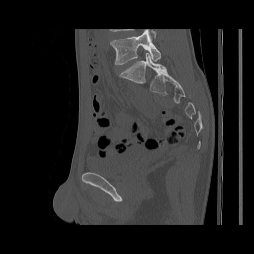 Normal pelvis (Radiopaedia 51473-57238 Sagittal bone window 68).jpg