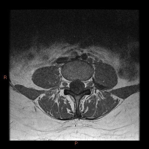 File:Normal spine MRI (Radiopaedia 77323-89408 Axial T1 13).jpg