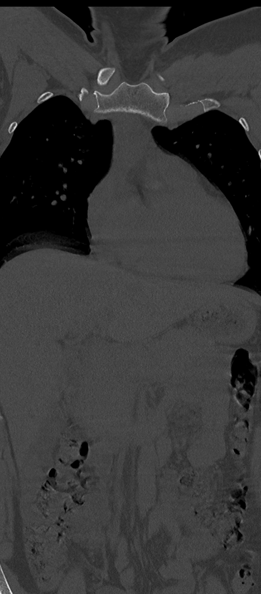 Normal thoracolumbar spine (Radiopaedia 43822-47309 Coronal bone window 10).png