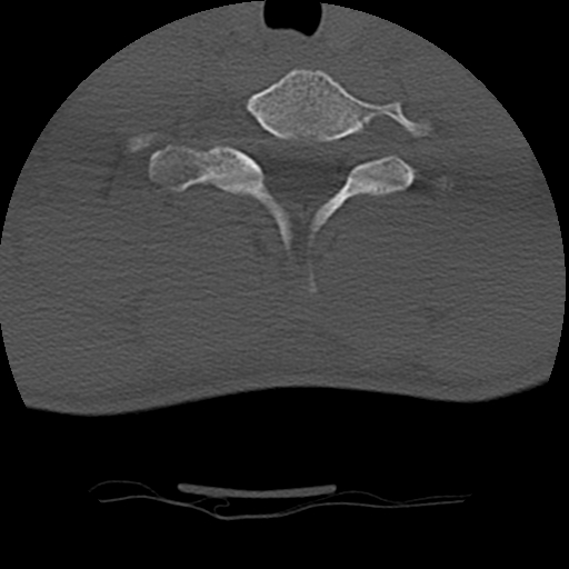 Normal trauma spine imaging (age 16) (Radiopaedia 45335-49358 Axial bone window 65).jpg