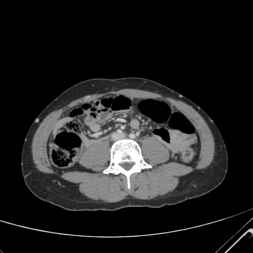 File:Nutmeg liver- Budd-Chiari syndrome (Radiopaedia 46234-50635 B 42).png