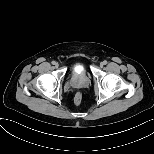 Obstructed upper pole ureter in a duplex kidney (Radiopaedia 54935-61221 Axial C+ delayed 109).jpg