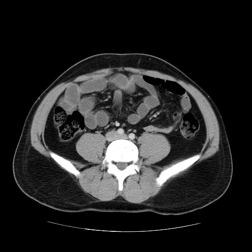 File:Obstructing ureteric calculus (Radiopaedia 18615-18514 B 35).jpg