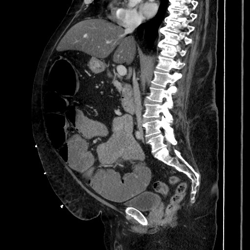 Obstructive colonic diverticular stricture (Radiopaedia 81085-94675 C 117).jpg