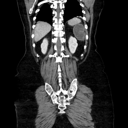 Obstructive distal colonic adenocarcinoma causing cecal perforation (Radiopaedia 86830-102989 C 139).jpg