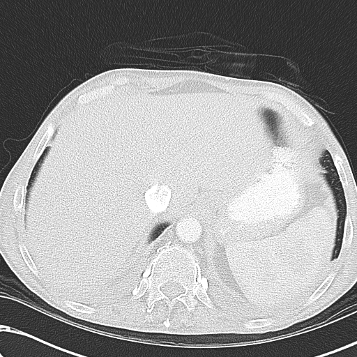 File:Obstructive superior vena cava tumor thrombus (Radiopaedia 28046-28306 Axial lung window 49).jpg