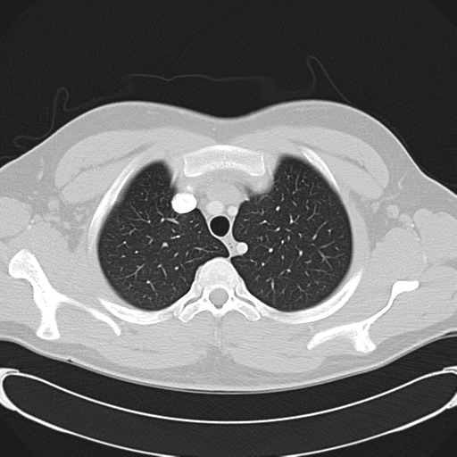'Bovine' aortic arch (Radiopaedia 33554-34637 Axial lung window 13).png