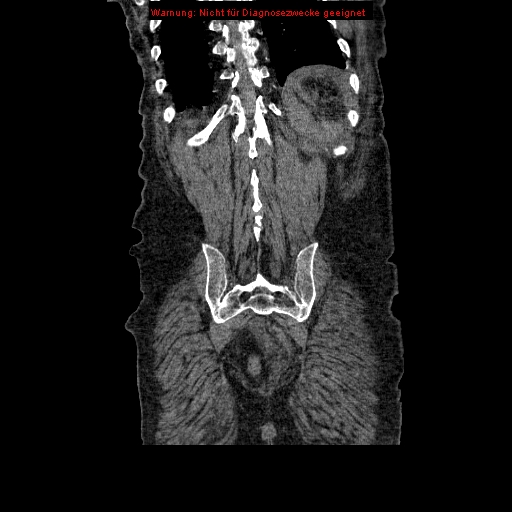 Abdominal aortic aneurysm- extremely large, ruptured (Radiopaedia 19882-19921 Coronal C+ arterial phase 90).jpg