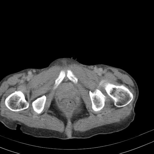 File:Abdominal aortic aneurysm (Radiopaedia 20827-20742 Axial C+ delayed 39).jpg