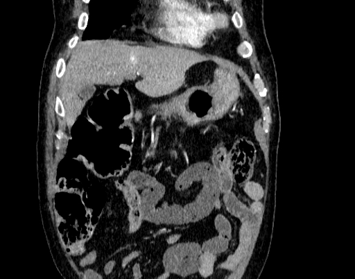 Abdominal aortic aneurysm (Radiopaedia 67117-76452 Coronal C+ arterial phase 6).jpg