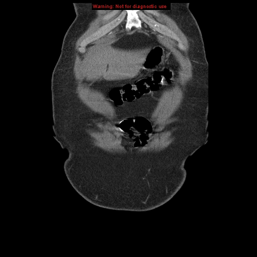 File:Abdominal aortic aneurysm (Radiopaedia 8190-9038 Coronal C+ arterial phase 13).jpg