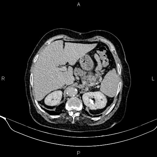 Abdominal aortic aneurysm (Radiopaedia 85063-100606 Axial C+ delayed 15).jpg