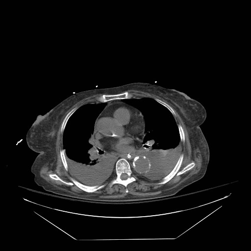 Abdominal aortic aneurysm - impending rupture (Radiopaedia 19233-19247 Axial non-contrast 4).jpg