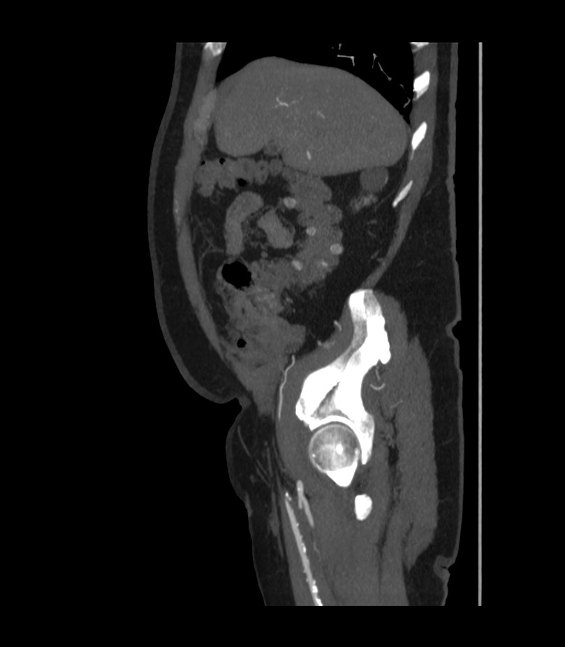 Abdominal aortic aneurysm with thrombus fissuration (Radiopaedia 46218-50618 Sagittal C+ arterial phase 12).jpg