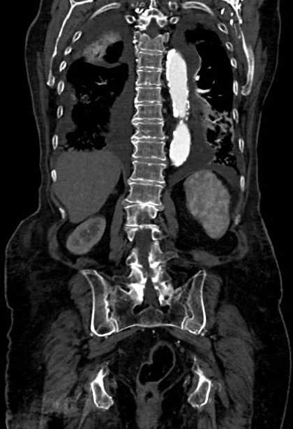 Abdominal aortic aneurysm with thrombus fissuration (Radiopaedia 73192-83919 Coronal C+ arterial phase 67).jpg