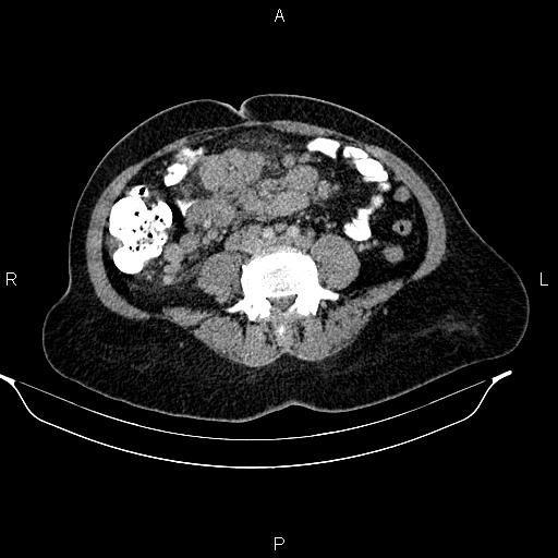 File:Abdominal lymphoma with sandwich sign (Radiopaedia 84378-99704 Axial C+ portal venous phase 37).jpg
