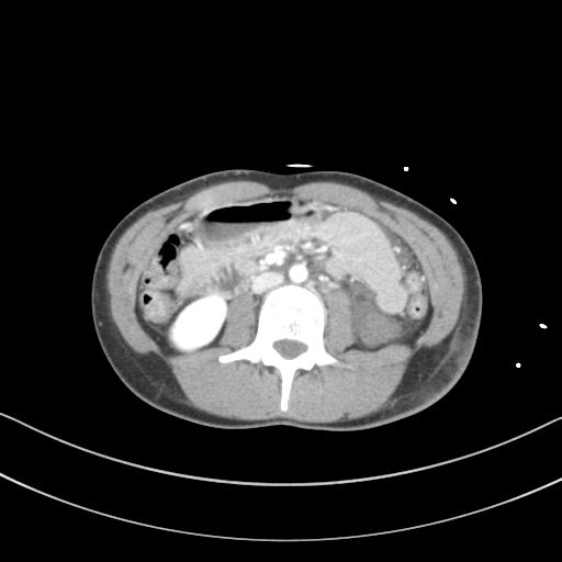 File:Abdominal multi-trauma - devascularised kidney and liver, spleen and pancreatic lacerations (Radiopaedia 34984-36486 Axial C+ portal venous phase 41).png