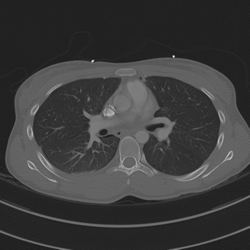 File:Abdominal multi-trauma - devascularised kidney and liver, spleen and pancreatic lacerations (Radiopaedia 34984-36486 I 40).png