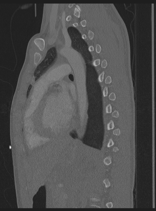Abdominal multi-trauma - devascularised kidney and liver, spleen and pancreatic lacerations (Radiopaedia 34984-36486 Sagittal bone window 19).png