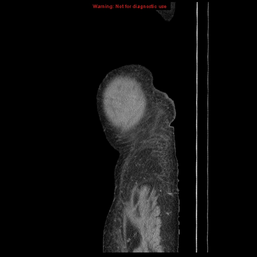 File:Abdominal wall hematoma (Radiopaedia 9427-10112 Sagittal C+ portal venous phase 6).jpg