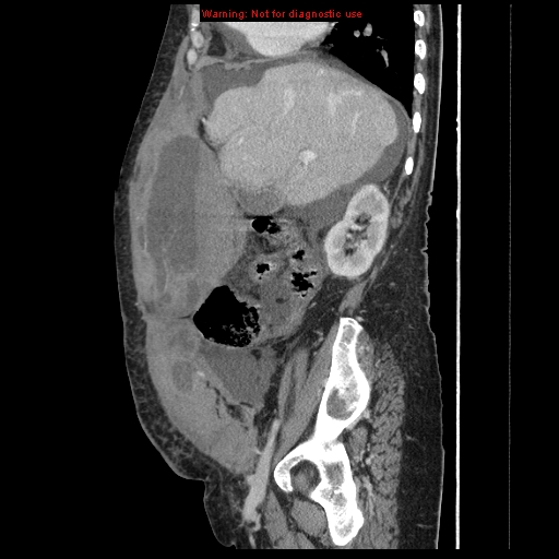 Abdominal wall hematoma (Radiopaedia 9427-10112 Sagittal C+ portal venous phase 74).jpg