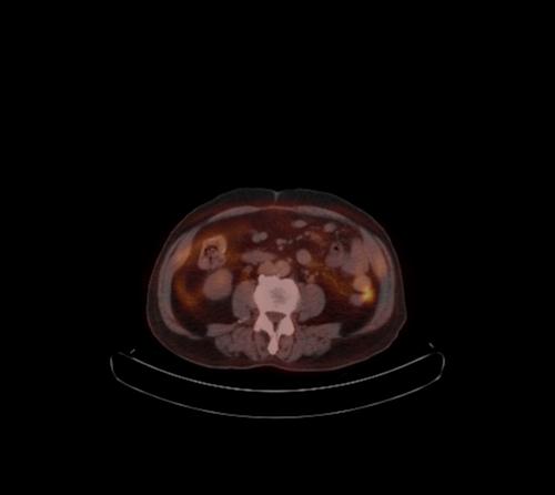 Abdominal wall metastasis from colorectal carcinoma (Radiopaedia 31016-31719 C 58).jpg