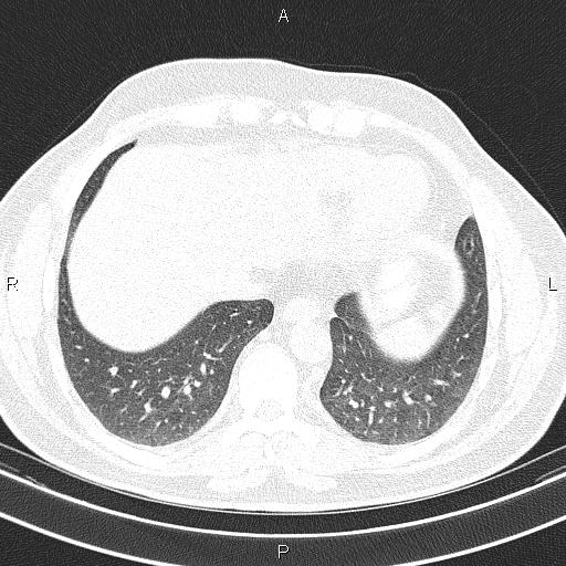 Aberrant right subclavian artery (Radiopaedia 87093-103354 Axial lung window 86).jpg