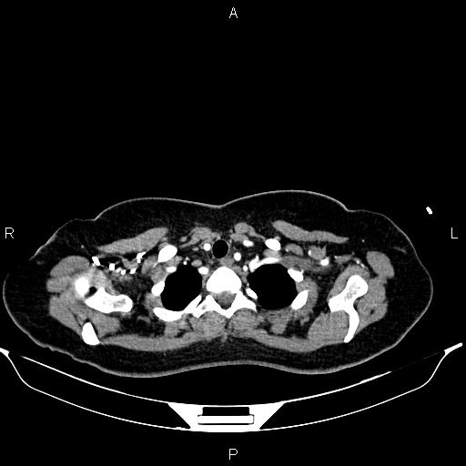 Aberrant right subclavian artery (Radiopaedia 87334-103629 Axial C+ arterial phase 10).jpg