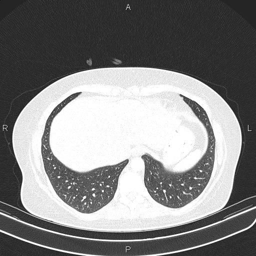 File:Aberrant right subclavian artery (Radiopaedia 87334-103629 Axial lung window 54).jpg