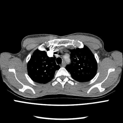 Accessory left horizontal fissure with lingular pneumonia (Radiopaedia 53763-59843 Axial C+ CTPA 22).jpg