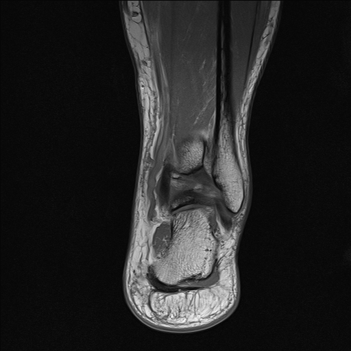 File:Achilles tendon tear (Radiopaedia 77615-89819 Coronal T1 21).jpg