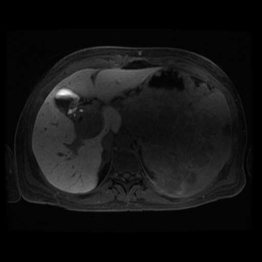 Acinar cell carcinoma of the pancreas (Radiopaedia 75442-86668 Axial late phase (~30 mins) 89).jpg