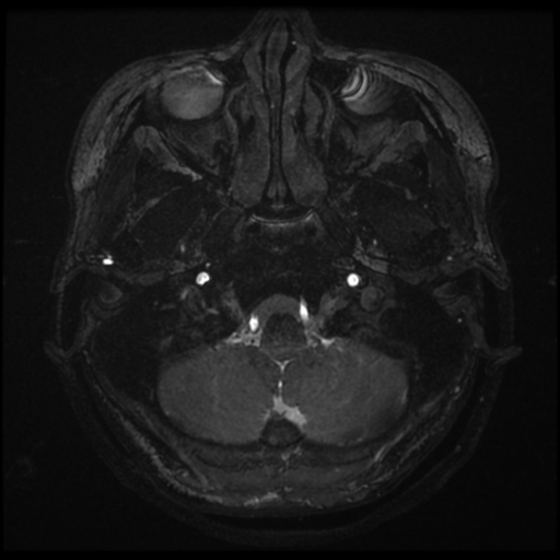 Acoustic neuroma (Radiopaedia 34049-35283 Axial 6).png