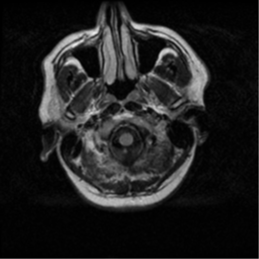File:Acoustic schwannoma (Radiopaedia 33045-34060 Axial FLAIR 1).png